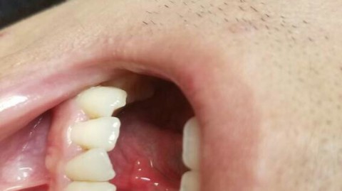 舌头下面长溃疡疼得受不了？快速缓解方法在这里